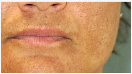 Nurturing Your Postpartum Skin ... (Part 3/5)
